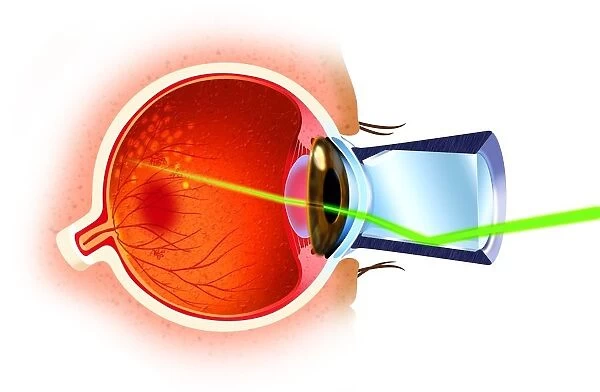 Cross section of eye ball, laser ray entering through pupil, directed at eye nerves