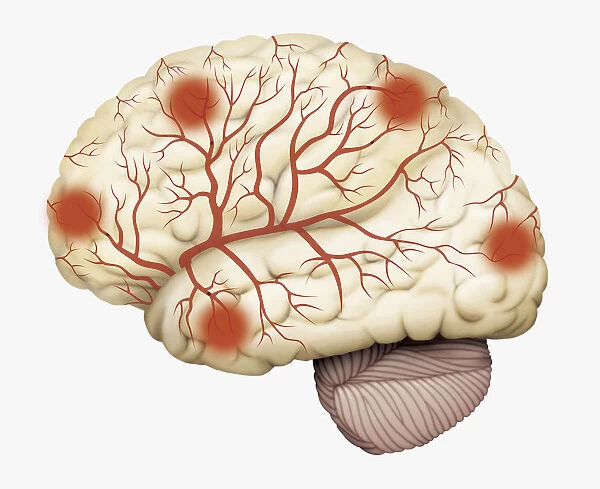 Digital illustration of human brain showing blood vessels, and areas of dead tissue highlighted in red