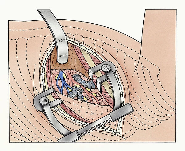Illustration of abdominal incision between ribs kept open by spreaders exposing human lung and blood vessels