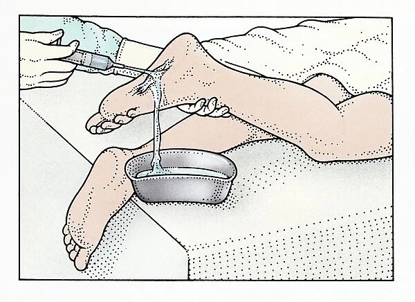 Illustration of using syringe to clean wound on sole of foot