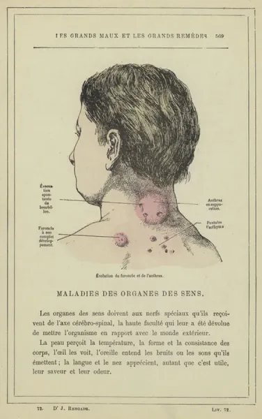 Furoncles Detailed View Of Ankle With Big Carbuncle Or Furuncle Stock