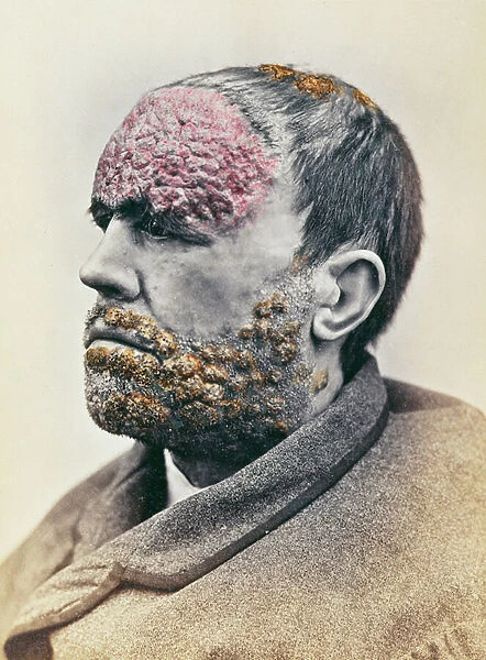 Man suffering from syphilis, from a photograph taken for the Clinique Photographique de