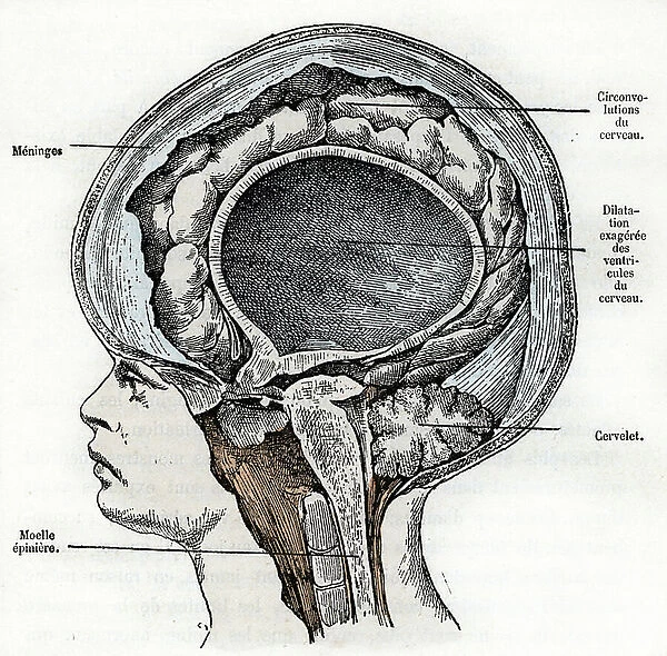 Representation of a young hydrocephal child with brain deformation (Hydrocephalus) Engraving from ' Nature and Man' by Rengade 1881 Private collection A