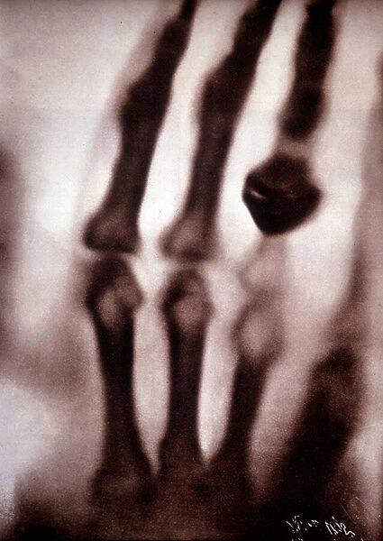 Roentgen rays (Rontgen) or X-rays First photograph: the hand of Roentgens wife