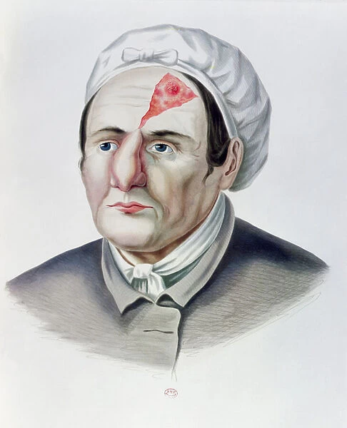After a skin graft operation, from Selecta Praxis Medico-Chirurgica