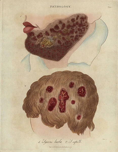 Sycosis of the beard and scalp, chronic inflammation of the hair follicles - Lithography by John Pass, published in 'Encyclopedia Londinensis' by John Wilkes, J.Adlard Edition, London, 1822