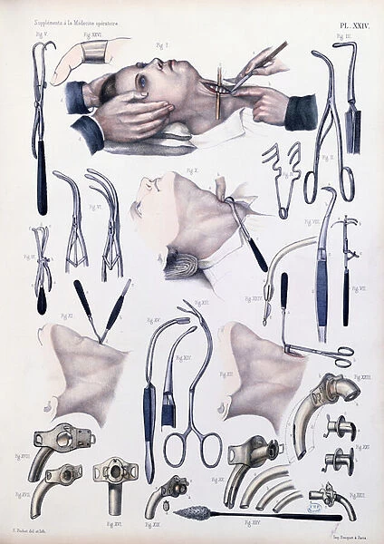 Tracheotomy operation, plate from Traite Complet de l Anatomie de l