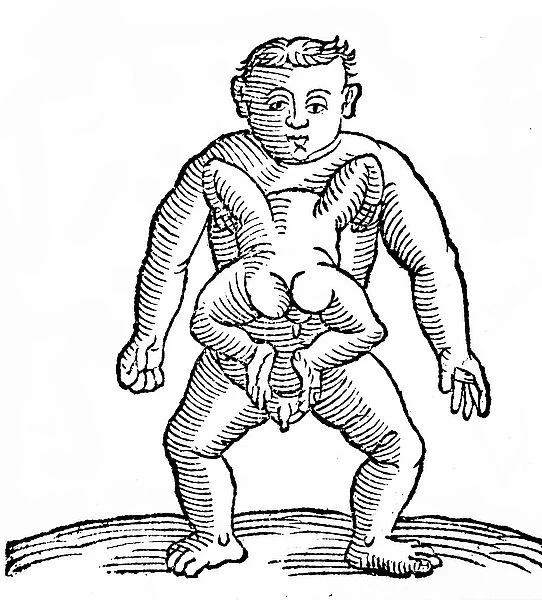 Woodcut showing a medieval or renaissance birth of conjoined (Siamese) twins, 15th century (engraving)