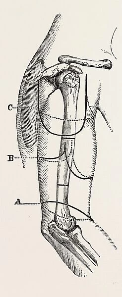 circular (inclined) amputation, medical equipment, surgical instrument, history of