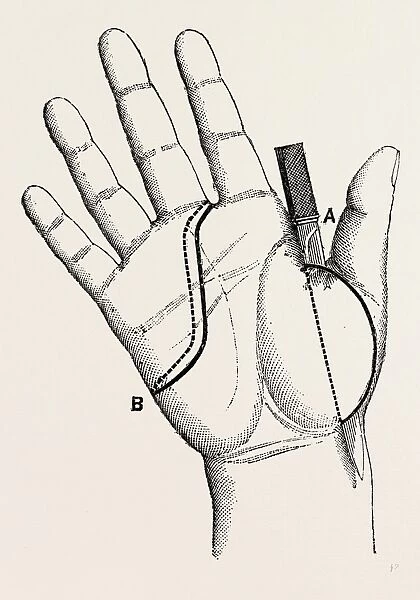 disartieulation of the thumb, medical equipment, surgical instrument, history of medicine