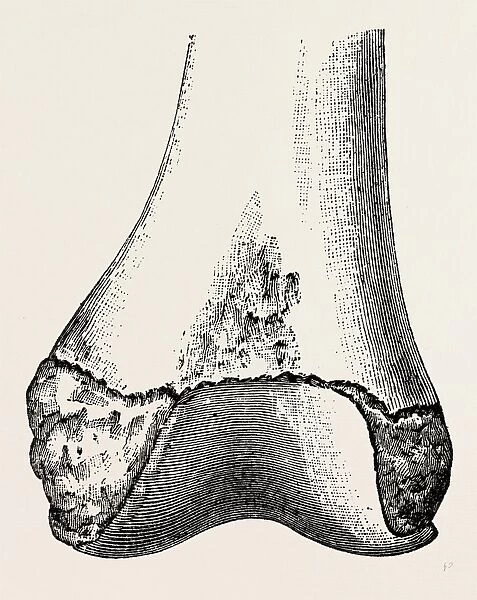 epiphyses of the femur, medical equipment, surgical instrument, history of medicine