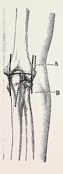 excision, medical equipment, surgical instrument, history of medicine