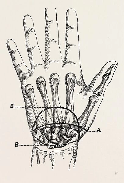 the first incision, palmar incision in the circular, medical equipment, surgical