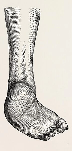 incurved form of the foot, the planzar, medical equipment, surgical instrument, history