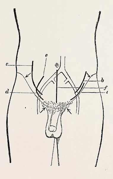 ligature of external iliac, medical equipment, surgical instrument, history of medicine