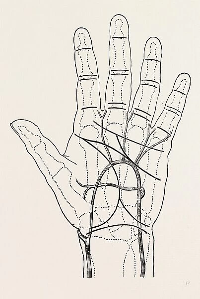 surface markings on the palm of ffile hand, the thick black lines represent the chief