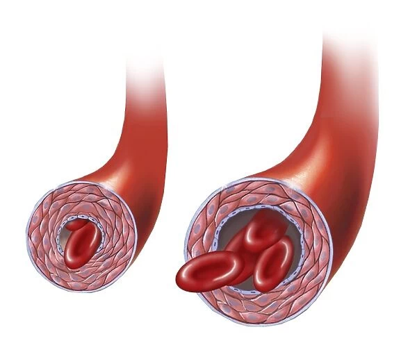 Normal artery versus artery in spasm