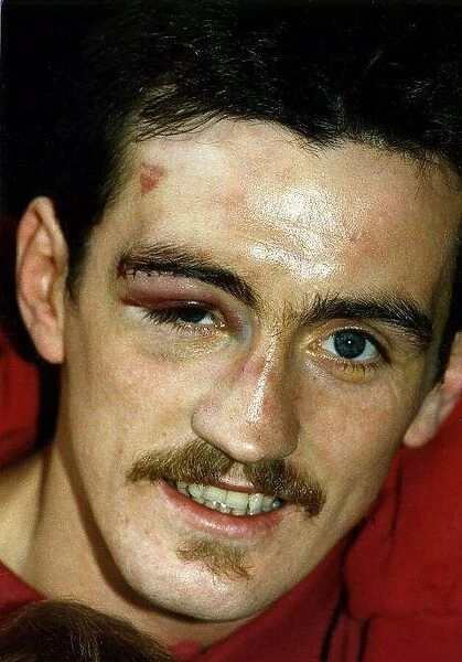 Boxer, Barry McGuigan, shows off his bruises after one of his fights. 1st June 1989