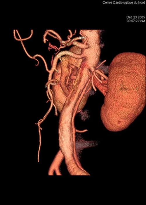 Framed Print : Aortic Aneurysm 3D Print