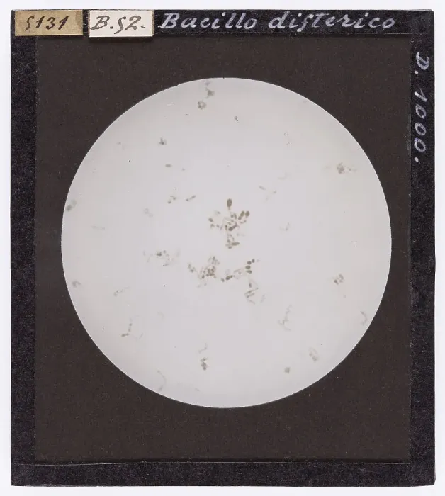 Framed Print : Diptheric bacillus, enlarged under a microscope Framed Print : Diptheric bacillus, enlarged under a microscope