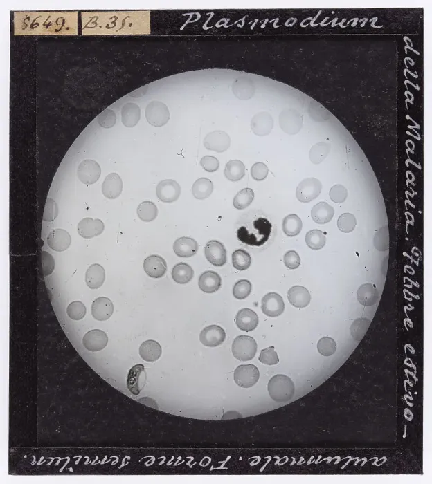 Framed Print : Malaria plasmodium enlarged under a microscope. Summer-Fall fever. Semi-lunar shapes Framed Print : Malaria plasmodium enlarged under a microscope. Summer-Fall fever. Semi-lunar shapes