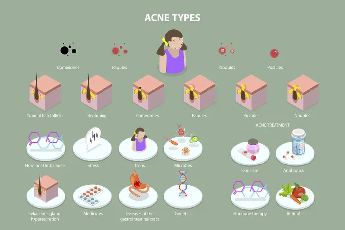 Framed Print : 3D Isometric Flat Vector Print of Acne Types and Skin Care Framed Print : 3D Isometric Flat Vector Print of Acne Types and Skin Care