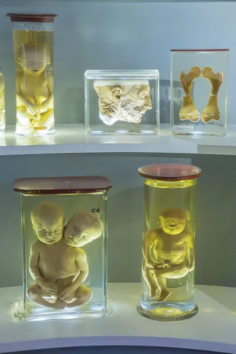 Framed Print : Human Deformity Skeleton Print, University Museum Groningen Framed Print : Human Deformity Skeleton Print, University Museum Groningen