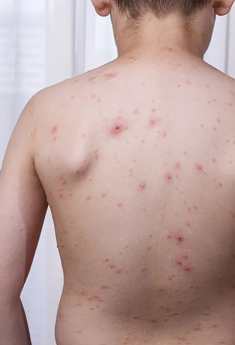 Framed Print : Chicken Pox Print: Child with Red Spots Framed Print : Chicken Pox Print: Child with Red Spots