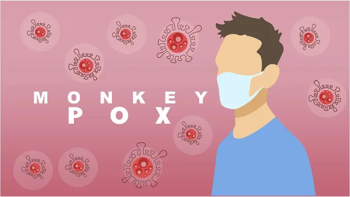 Framed Print : Monkeypox Virus Print Illustration Framed Print : Monkeypox Virus Print Illustration