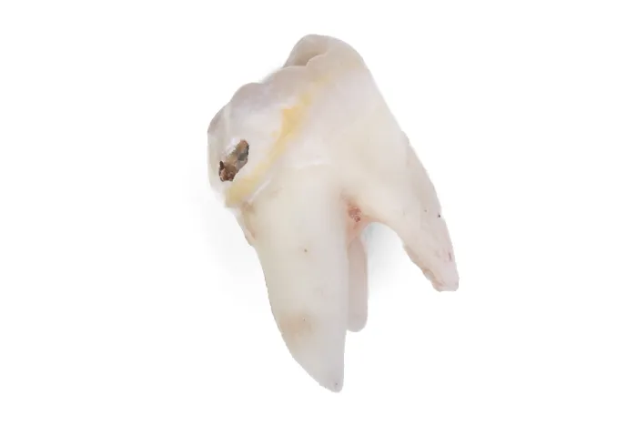 Framed Print : Pulled Wisdom Tooth Print - Carious and Damaged Framed Print : Pulled Wisdom Tooth Print - Carious and Damaged