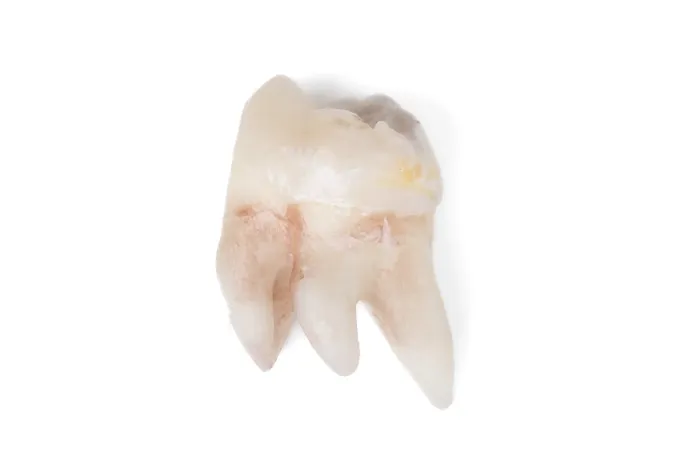 Framed Print : Pulled Wisdom Tooth Print - Dental Procedure Framed Print : Pulled Wisdom Tooth Print - Dental Procedure