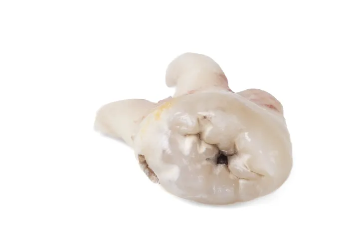 Framed Print : Pulled Wisdom Tooth Print: Carious and Damaged Framed Print : Pulled Wisdom Tooth Print: Carious and Damaged