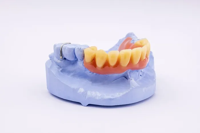 Framed Print : Removable Denture of Upper Jaw Print Framed Print : Removable Denture of Upper Jaw Print