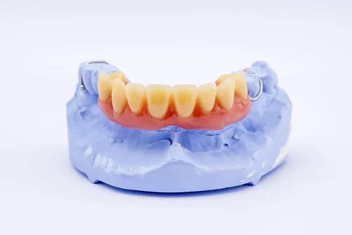 Framed Print : Removable Denture of Upper Jaw Print Framed Print : Removable Denture of Upper Jaw Print