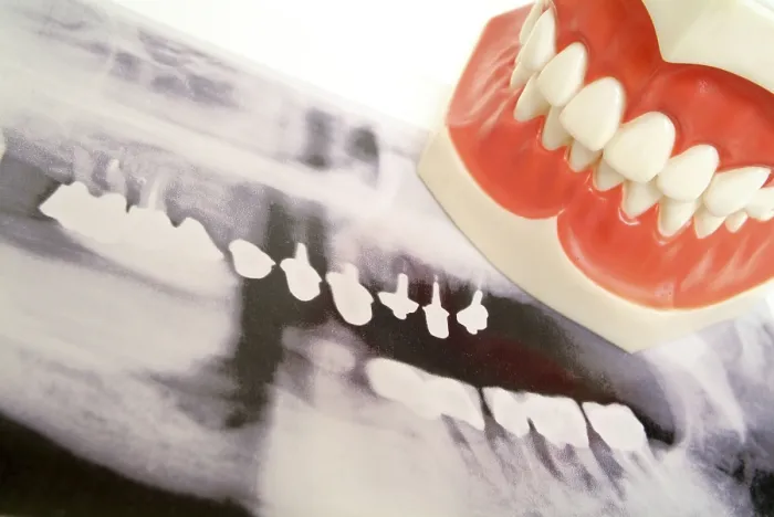 Framed Print : Tooth X-ray Print Framed Print : Tooth X-ray Print