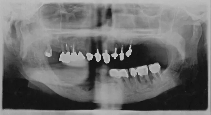 Framed Print : Tooth X-ray Print Framed Print : Tooth X-ray Print