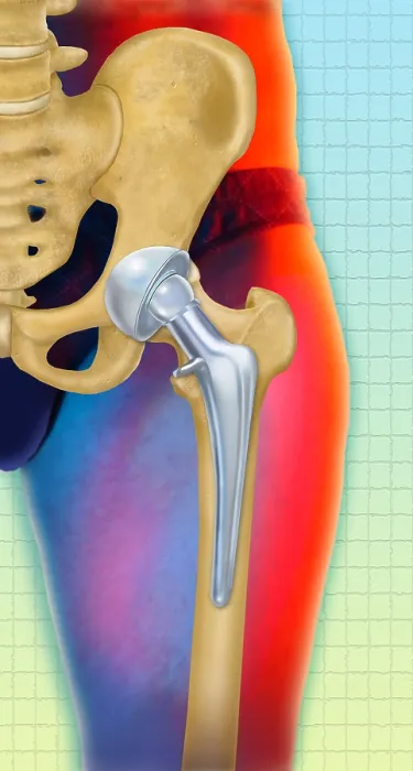 Framed Print : Prosthetic Hip Replacement Print Framed Print : Prosthetic Hip Replacement Print