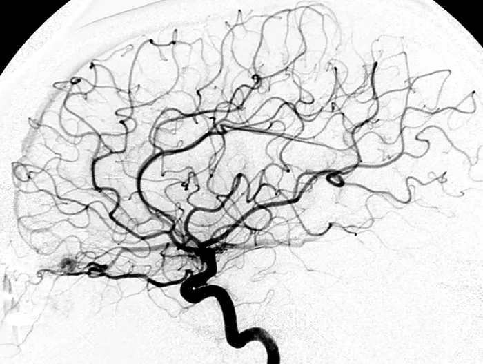 Framed Print : Cerebral Angiogram Print of dAVF Framed Print : Cerebral Angiogram Print of dAVF