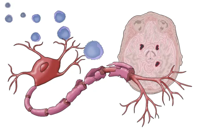 Framed Print : Multiple Sclerosis Print - Demyelinated Nerve Cells Framed Print : Multiple Sclerosis Print - Demyelinated Nerve Cells