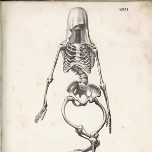 Skeleton of Rickets