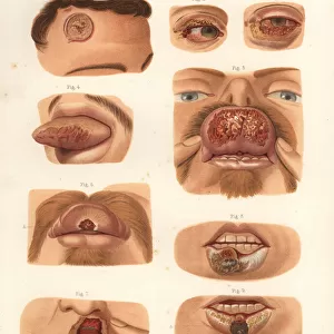 Syphilitic chancres on the face