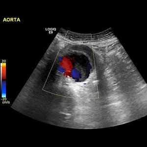 Abdominal aortic aneurysm, ultrasound C017 / 7646