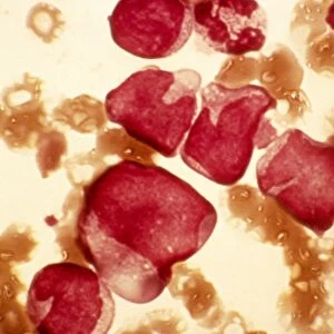 Acute myeloid leukaemia, micrograph