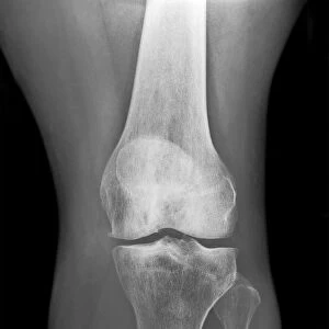 Amputated lower leg, X-ray C017 / 7644