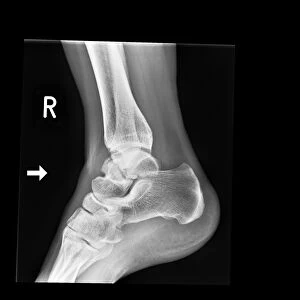 Ankle bone fracture, X-ray C017 / 7809