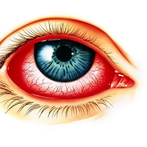 Artwork showing eye with allergic conjunctivitis