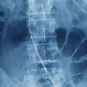 Balloon angioplasty, X-ray