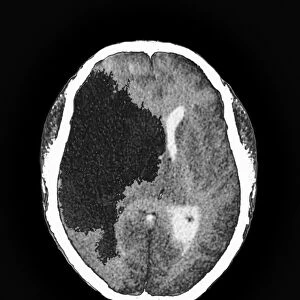 Berry aneurysm, MRI scan