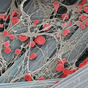 Blood clot on plaster, SEM