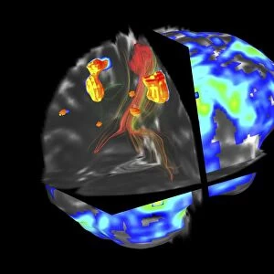 Brain tumour, fMRI and tractography C017 / 7102